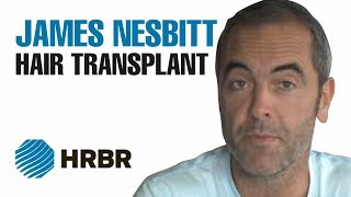 Actor James Nesbitt Hair Transplant Surgery Video Testimonial