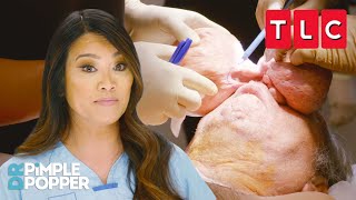WILDEST Removals Part 3  Dr Pimple Popper  TLC