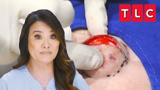 Dr Lee Squeezes Devil Horn Cyst off the Forehead of a Patient  Dr Pimple Popper  TLC