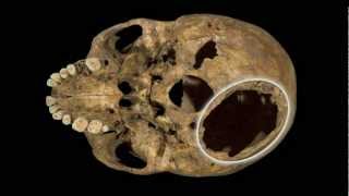 Richard III  Injuries to the Remains